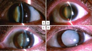 What Is An Immature Cataract, And How Is It Treated?
