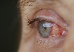 Failure Rate Of Cataract Surgery