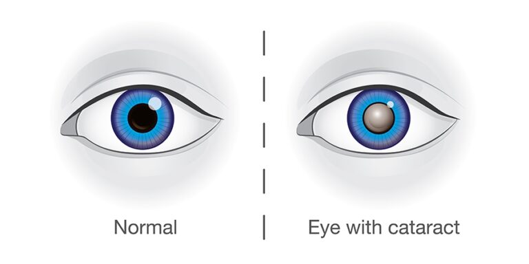 Left Eye Inward Left Eye Cataract- How Can You Treat It?