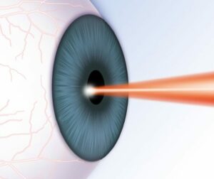 How To Select From Different LASIK Options?