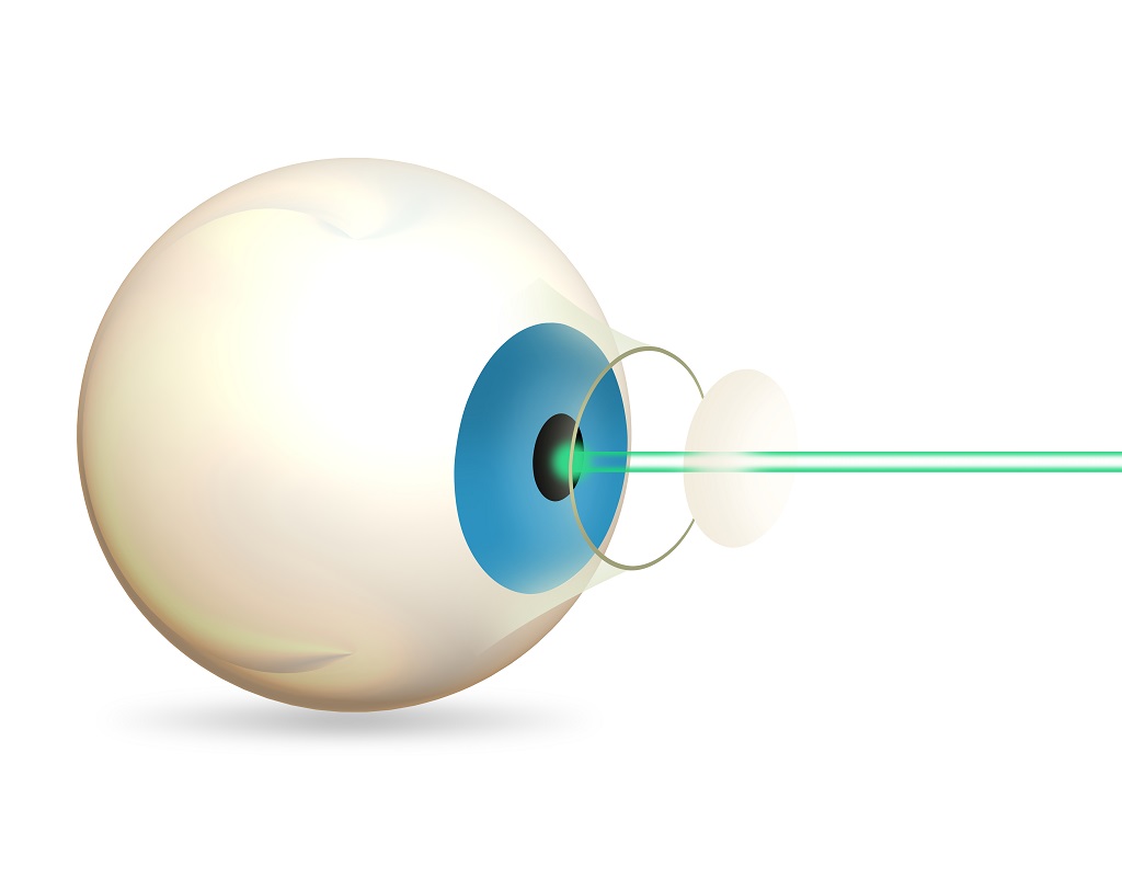 I-LASIK : Procedure, Benefits and Side-Effects