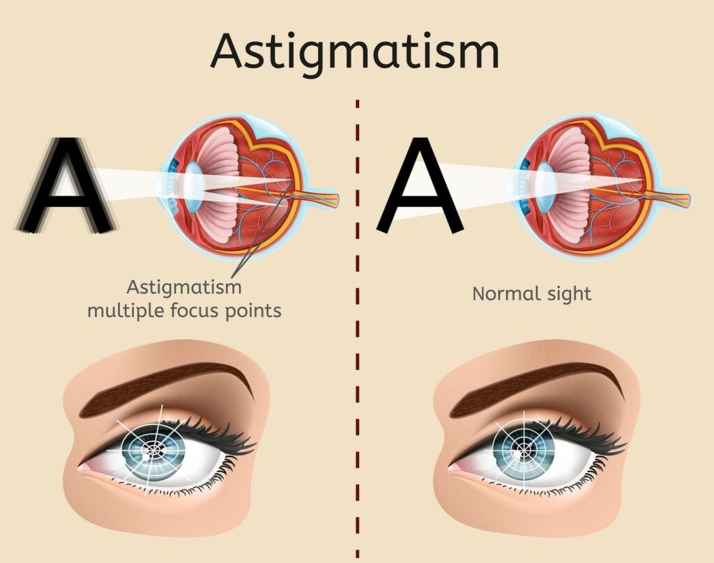 LASIK for Astigmatism | Procedure of LASIK for Astigmatism