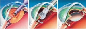 Intraocular Lens Implant
