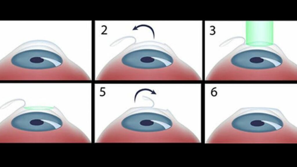 Lasik Surgery: What Is It? How Does It Work, And How Much Does It Cost?