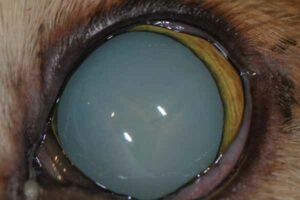 What is an Incipient Cataract?