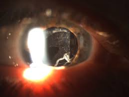 What Is a Diabetic Cataract?