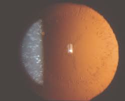 What is a Glass Blowers Cataract?