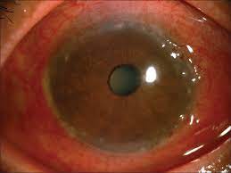 What is an Immature Cataract?