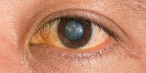 What Is An Immature Senile Cataract?