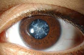 What Is Left Eye Cataract?