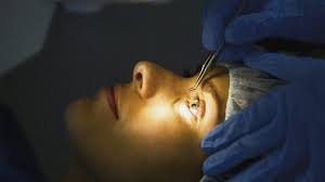 What is Eye Surgery?