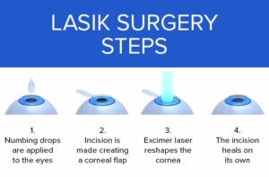 What is Lasik Surgery?