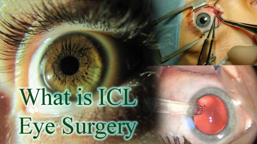 What Is ICL Surgery? And What Are Its Treatment Options