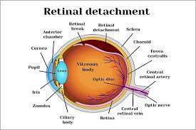 Family history of retinal detachment
