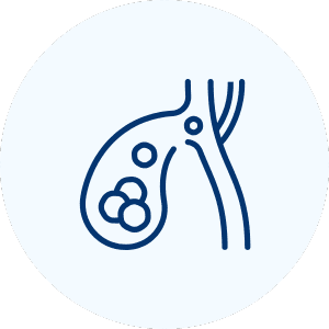 Gallstone