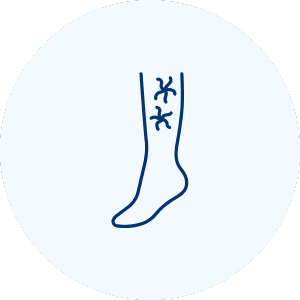 Varicose Veins