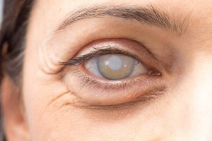 Complications from cataract removal surgery